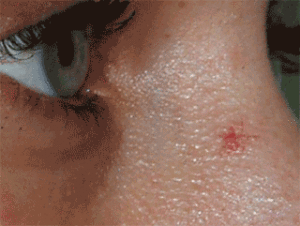 weblesiones-faciales2