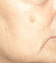 Eliminación de manchas faciales