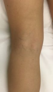 Resultados tras 2 sesiones de tratamiento vascular en la pierna