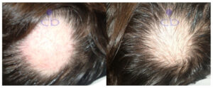 tratamiento alopecia decabobove