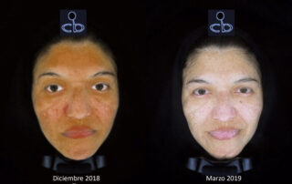 Tratamiento Melasma Clínica Decabobove