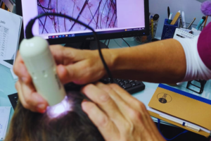 alopecia androgenética: tratamiento médico en Martorell